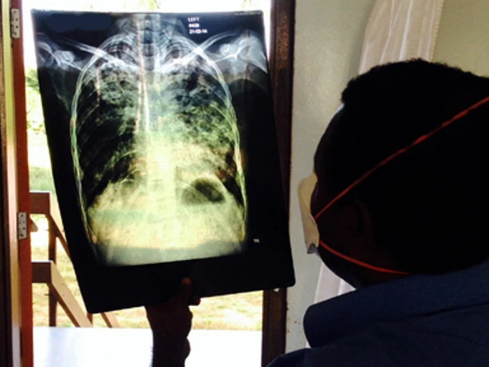 TB Physician Dr. Stenard Hiashiri Reviewing A Chest X Ray Of A Patient With Tuberculosis NO Patient ID 510X288