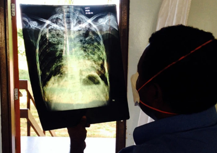 TB Physician Dr. Stenard Hiashiri Reviewing A Chest X Ray Of A Patient With Tuberculosis 510X288